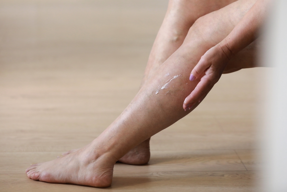 Varices – prévention et aide